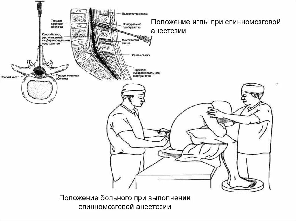 Положение больного при спинномозговой анестезии. Спинально эпидуральная анестезия техника проведения. Спинальная анестезия алгоритм выполнения. Положение пациента при эпидуральной анестезии. Пункция через задний свод