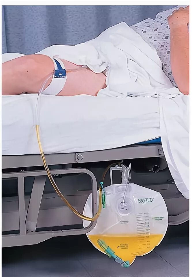 Катетер для капельницы. Катетер фолея алгоритм. Хожу с катетером. Нефростома катетер. Хожу с катетером.