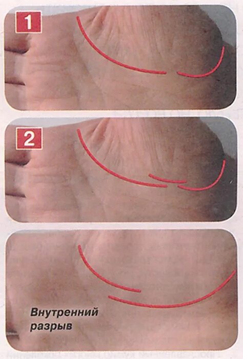 Разрыв линии жизни на руке. Линия жизни на руке с разрывом. Внутренний разрыв линии жизни. Перекрывающийся разрыв на линии жизни. Внешний разрыв линии жизни.