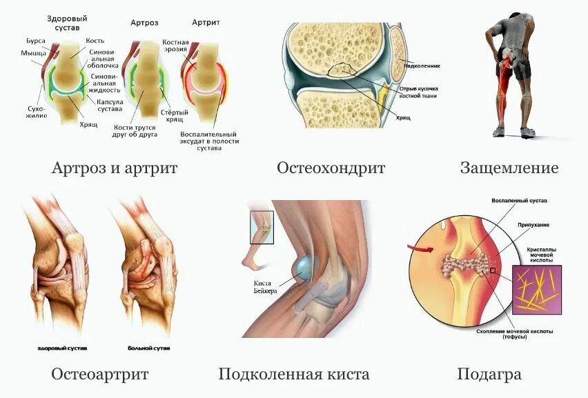 Заболевание коленного сустава диагноз. Воспаление коленного сустава диагноз. Заболевач коленного сустава. Заболевания суставов коленей.