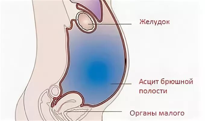 Асцит в малом тазу