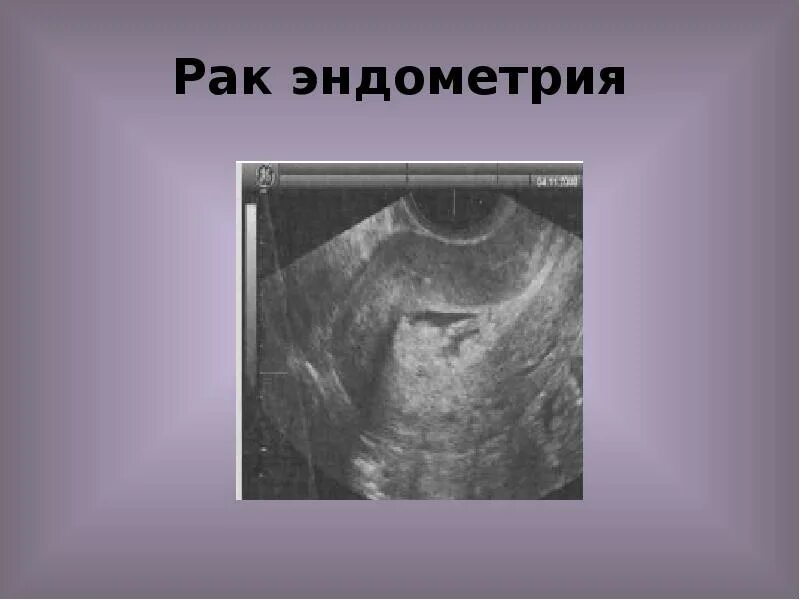 Картинки ЭНДОМЕТРИЙ ПРИ РАКЕ ЭНДОМЕТРИЯ