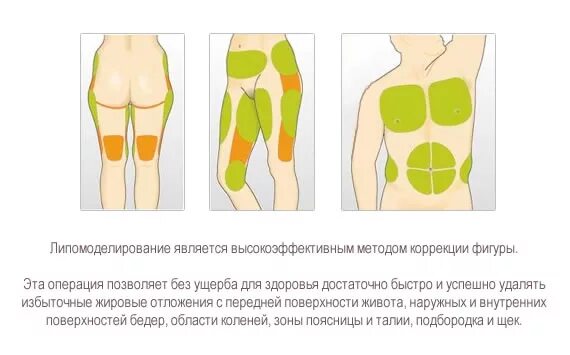 Проблемные зоны тела у женщин. Схемы введения липолитиков. Проблемные места у женщин. Зоны липосакции. Липосакция круговая живота спины бока.