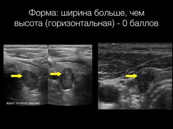 Эхогенный фокус лж. Лексикон тирадс УЗИ. Тирадс щитовидной железы по УЗИ. Признаки тирадс 3 по УЗИ. Ti rads 3 в щитовидной