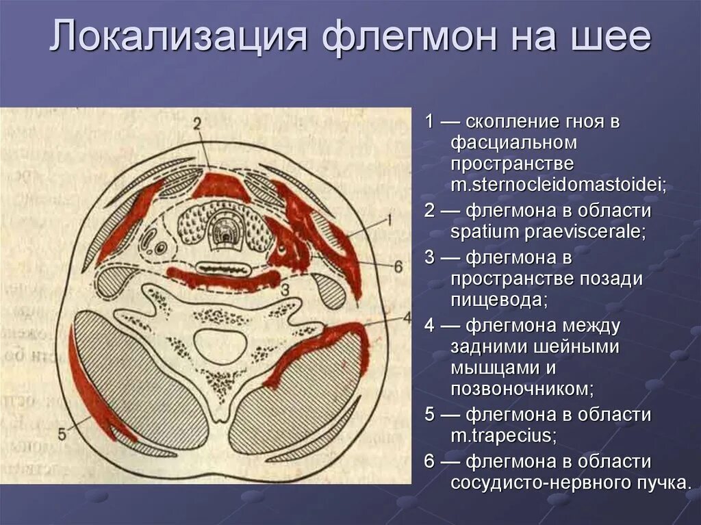 Spatium retropharyngeum. Флегмона клетчаточного пространства шеи. Заболевания клетчаточных пространств шеи. Локализация флегмон шеи. Пространства шеи.