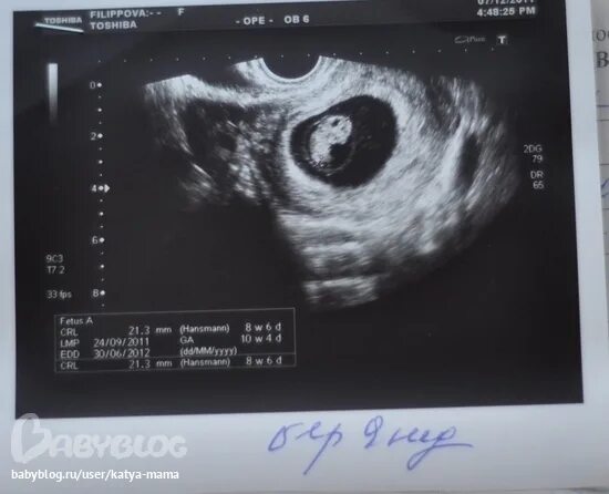 9 Week 6 Day Ultrasound Twins Factory Sale glomart.kz