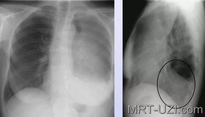 флюорография увидит рак легких