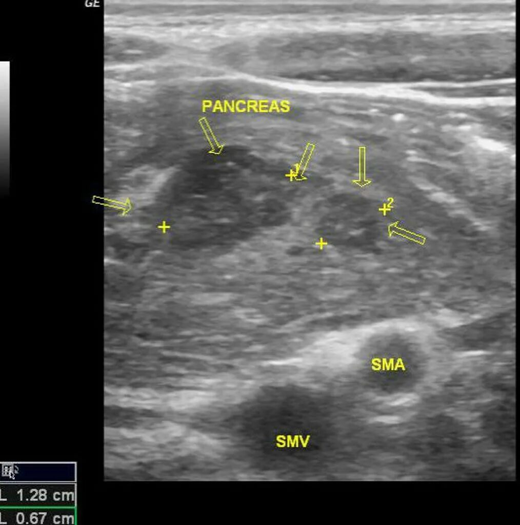 Поджелудочная железа на УЗИ липофиброз. Фиброз поджелудочной железы на УЗИ. Фиброз липоматоз поджелудочной железы. Фибролипоматоз поджелудочной железы на УЗИ. Поджелудочная эхогенность повышена диффузно