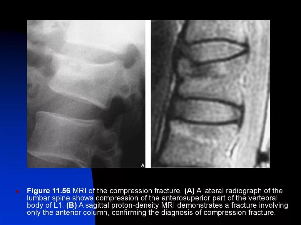 Компрессионный перелом позвоночника т4. Компрессионный перелом позвоночника th11-l1. Компрессионный перелом позвонка кт. Компрессионный перелом тела л2 позвонка. Компрессионный перелом тела 1 1