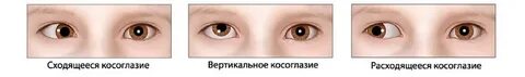 Сходящееся косоглазие код по мкб у детей