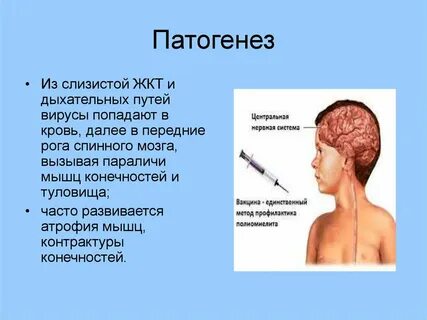 Полиомиелит симптомы у взрослых