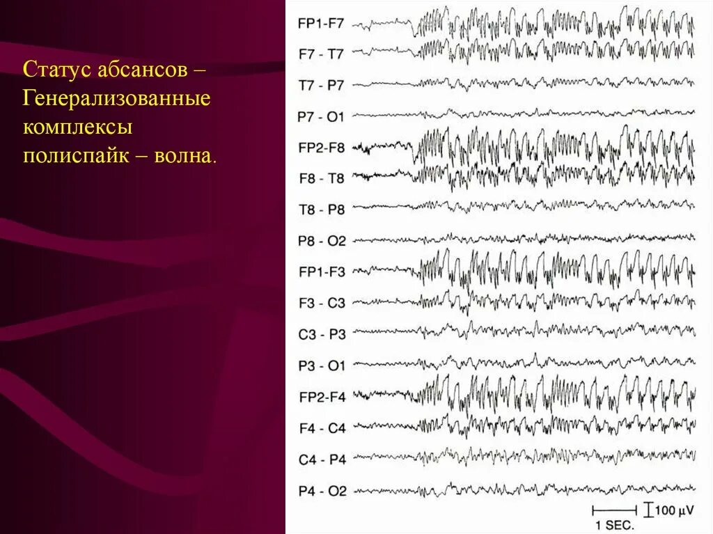 Медленные волны на ээг. Спайк волновая активность на ЭЭГ. Комплекс Спайк полиспайк на ЭЭГ. Комплекс Спайк медленная волна на ЭЭГ. Абсанс ЭЭГ паттерн.