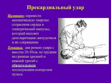 Нанесение прекардиального удара в область грудины