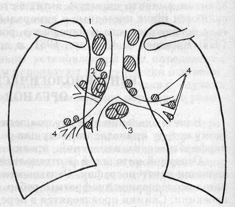 Туберкулез внутригрудных лимфоузлов. Туберкулез внутригрудных лимфатических лимфоузлов. Лимфатические узлы средостения схема. Лимфоузлы средостения рентген. Увеличение лимфоузлов в легких причины