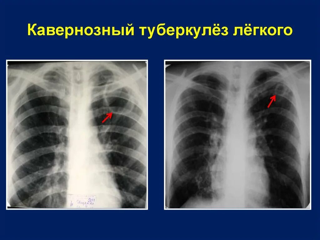 Фиброзно-кавернозный туберкулез рентген. Фиьрощно кавкрнойзный туберкулёз рентген. Кавернозный туберкулез легких рентген. Рентген фибиринозно-кавернозый туберкулез.