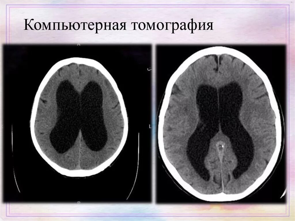 Выраженная заместительная гидроцефалия. Окклюзионная гидроцефалия кт. Компьютерная томография головного мозга гидроцефалия. Гидроцефалия головного мозга на кт. Гидроцефалия головного мозга мрт.