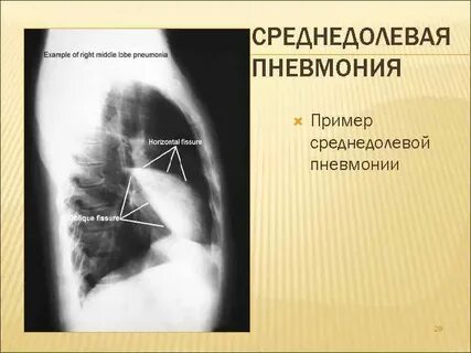 Внебольничная правосторонняя пневмония