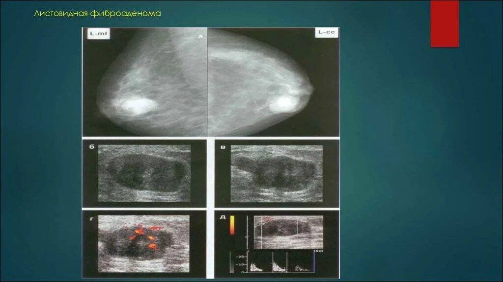 Фиброаденома молочной железы что это лечение. Филлоидная опухоль молочной железы УЗИ. Листовидная форма фиброаденомы. Филлоидная фиброаденома на УЗИ. УЗИ молочных желез фиброаденома УЗИ.