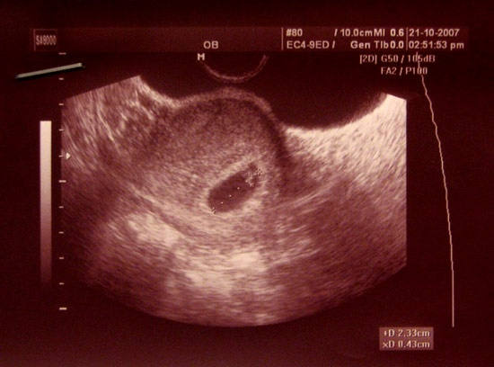 Эмбрион на 5 неделе беременности УЗИ. УЗИ на 5 неделе беременности. УЗИ 6 недель беременности.