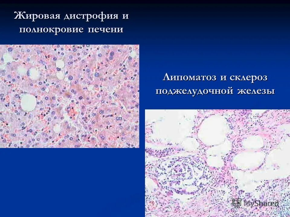 Стеатоз печени гистология. Жировое Перерождение поджелудочной железы. Стеатоз поджелудочной железы гистология. 1. Жировая дистрофия печени. Что такое стеатоз поджелудочной железы