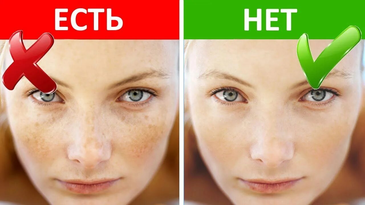 Избавилась от веснушек на лице. Как убрать веснушки. Девушка с веснушками. Как избавиться от веснушек. Как избавиться от веснушек.