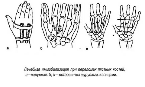 Перелом костей рук и пальцев