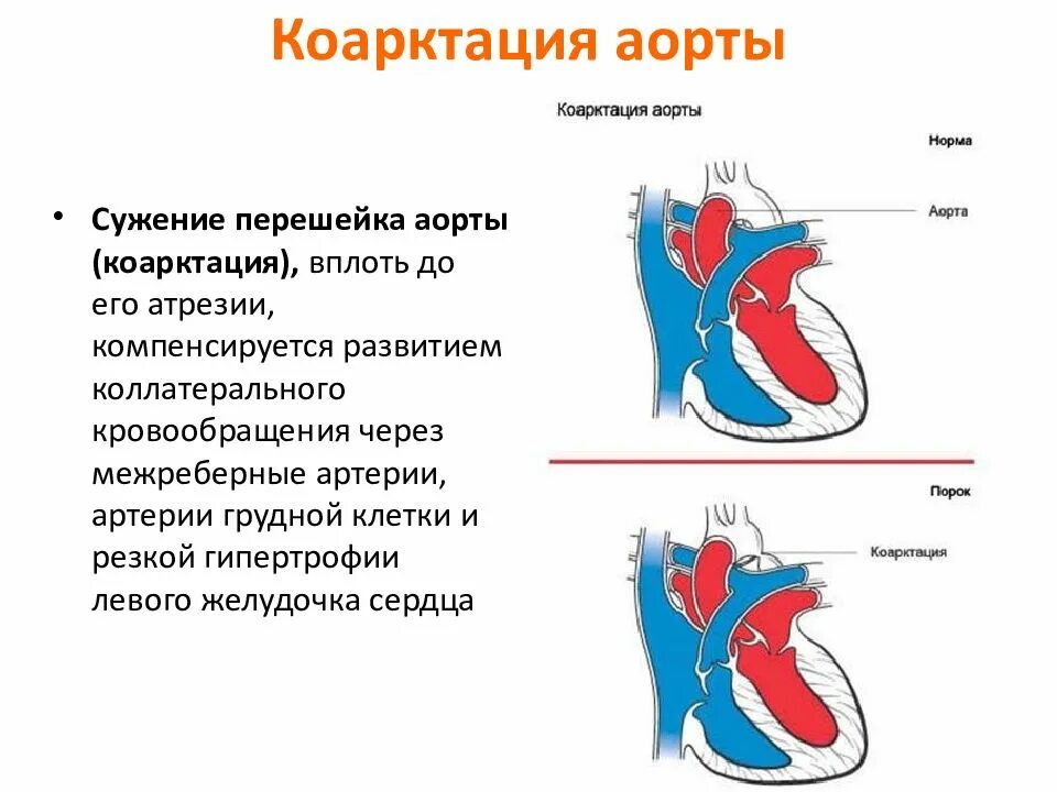 Незначительный стеноз. Коарктация брюшной аорты. стеноз аортального клапана новорожденного. порок сердца коарктация аорты.