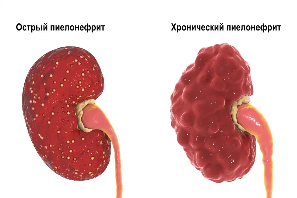 Пиелонефрит мочевого пузыря. Острый и хронический пиелонефрит. Хронический пиелонефрит почек.