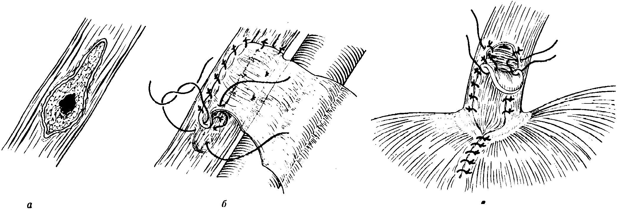 Ушивание разрывов. Операции ушивания РАН пищевода.. Перфорация пищевода ушивается.