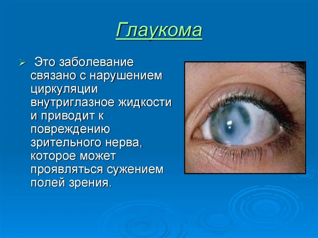 Причины глаукомы глаза. Сообщение о заболеваниях глаз. Глазные болезни презентация. Заболевание глаз глаукома.