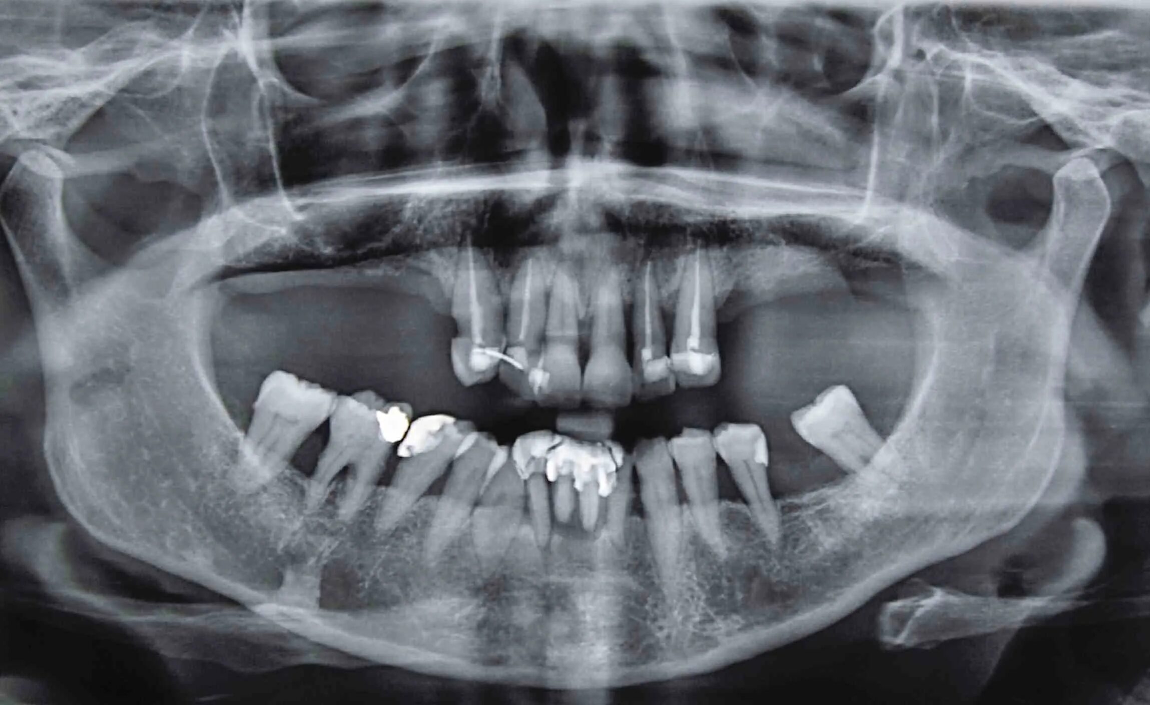 Ортопантомография пародонтит. Пародонтоз ортопантомография. Рентген ортопантомограмма зубов.