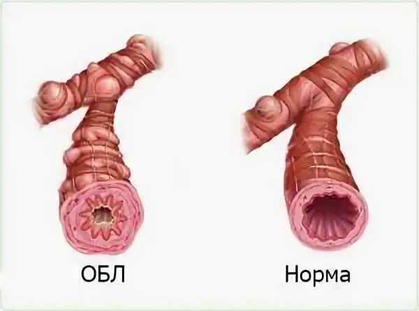 Трахеобронхит без кашля. Трахеобронхит без кашля
