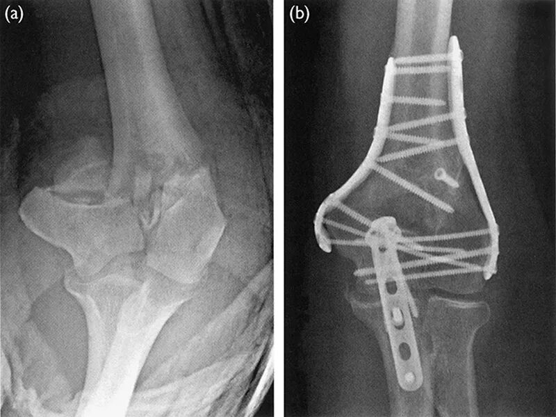 Внутрисуставной перелом мыщелка. Остеосинтез локтевого сустава. Остеосинтез мыщелков плечевой. Мыщелка плечевоцкости. Чрезмыщелковый перелом плечевой.