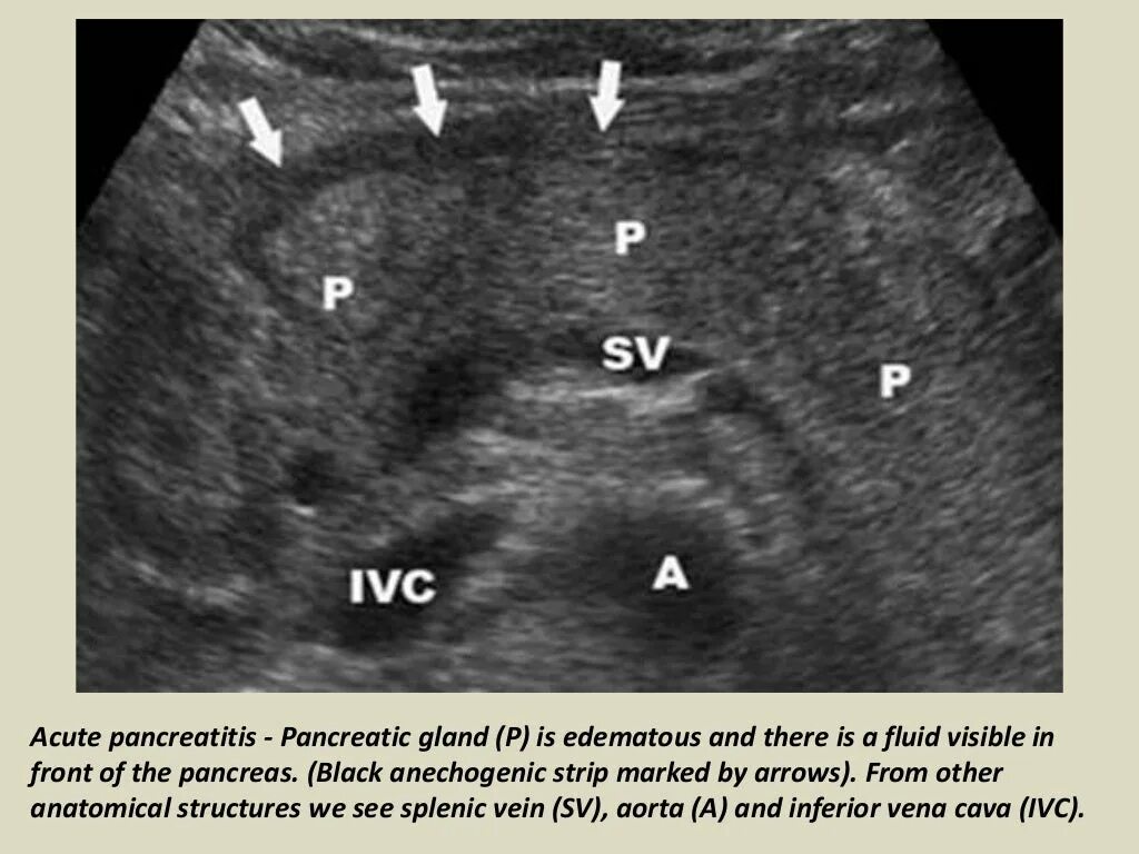 УЗИ брюшной полости поджелудочная железа. Эхограмма поджелудочной железы. Кольцевидная поджелудочная железа УЗИ. Ультрасонограмма поджелудочной железы.