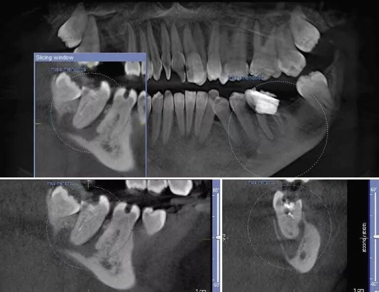Снимок зубов видное. Периостит челюсти рентген. Периодонтит рентген челюсти. Периостит нижней челюсти рентген. Радикулярная киста нижней челюсти.