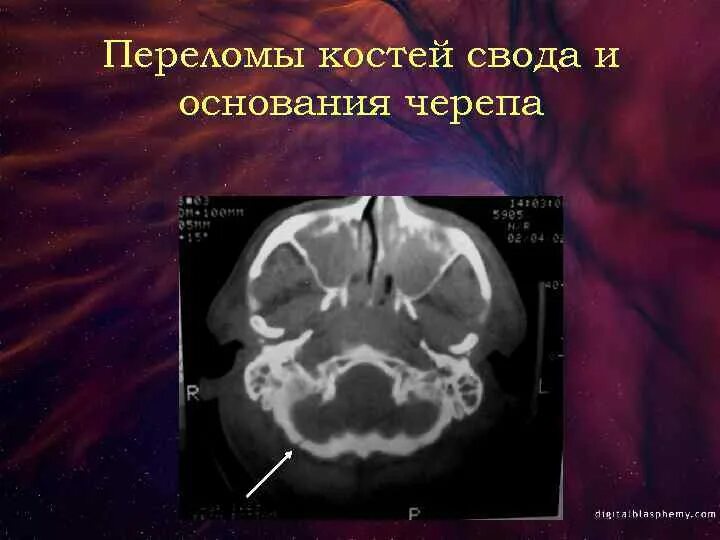 Перелом кости свода черепа. Перелом свода черепа, перелом основания черепа. Ликворея при переломе основания черепа. ЧМТ перелом свода черепа. Перелом костей свода и основания черепа.