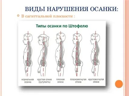 Этапы нарушения осанки