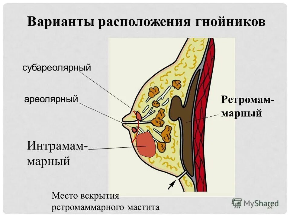 Диффузная мастопатия маммограмма. Молочные железы уплотнены. Лактационный и нелактационный мастит. Молочные железы уплотнены. Маммограмма фиброаденома.