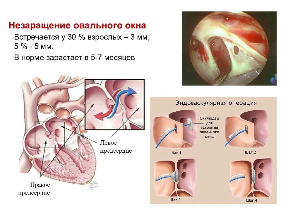 Окно в сердце у ребенка. Открытое овальное окно в сердце. Открытое овальное окно в сердце у ребенка. Закрытие овального окна в норме. Незаращение овального окна.