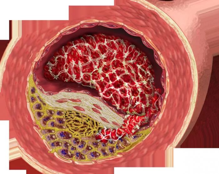 Атеросклероз бляшки сосудов. Атеросклероз сосудов макропрепарат. Атеросклероз холестериновая бляшка. Атеросклероз пенильных артерий.