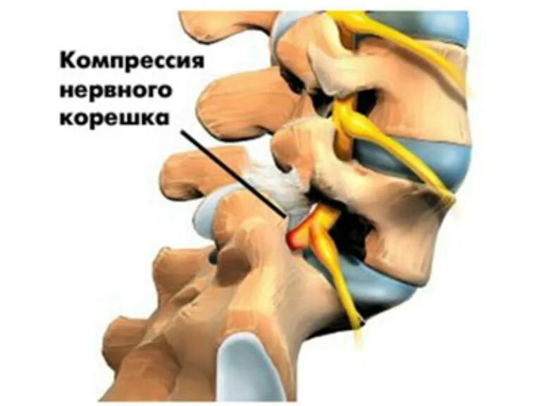 Защемление корешков в пояснице. Поражение Корешков спинномозговых нервов. Поражение нервных Корешков поясничного отдела позвоночника. Сдавление Корешков шейного отдела позвоночника. Компрессия нервных Корешков позвоночника поясничного отдела.