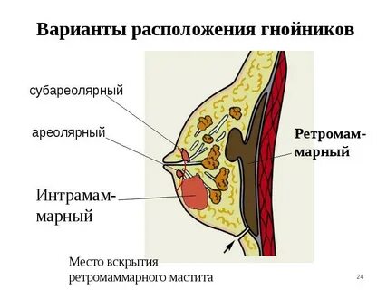 Уплотнение после мастита