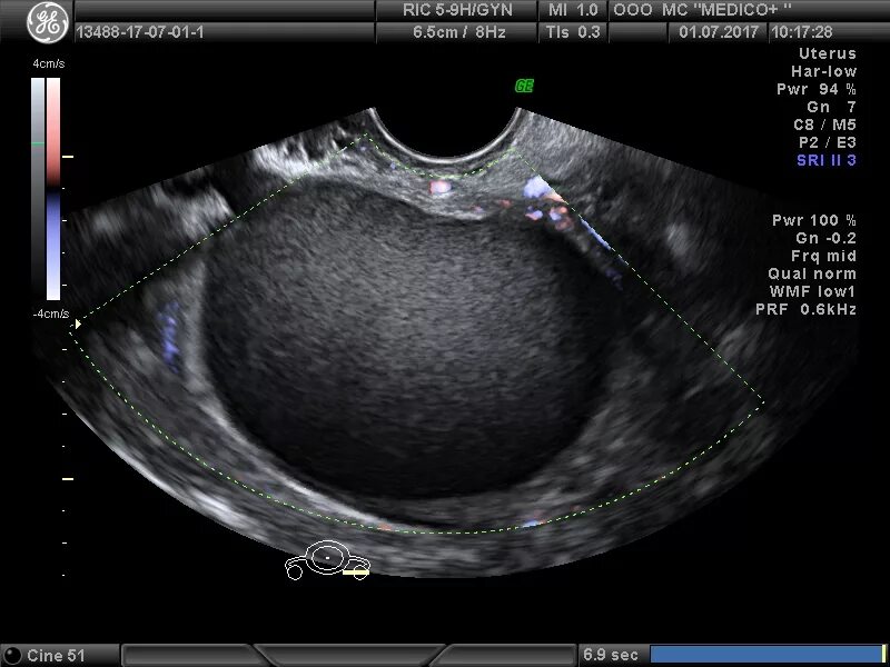 Эндометриоидная киста яичника. Эндометриоидная киста яичника на УЗИ. Киста яичника снимок УЗИ. Эндометриоидная киста яичника ЦДК.