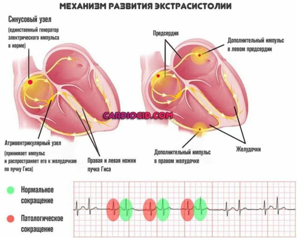 Фибрилляция предсердий механизм развития. Механизм формирования фибрилляции предсердий. Трепетание предсердий механизм развития. Механизм образования фибрилляции предсердий. Предсердие болезни