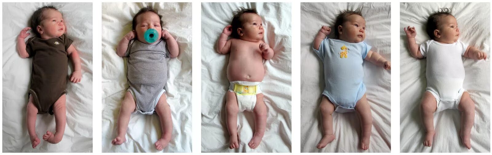 Месяцев первые изменения. Новорожденный с ахондроплазией. Изменение ребенка по месяцам. Ахондроплазия у грудничка. Ноги новорожденных по месяцам.
