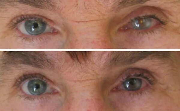 девушка с удаленным глазом. как выглядит глаз после удаления. как выглядит глаз после удаления. энуклеация глазного яблока. как выглядит глаз после удаления.