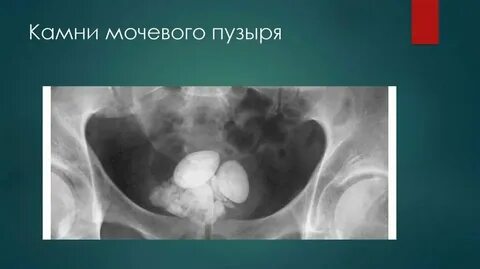 Как убирают камни в мочевом