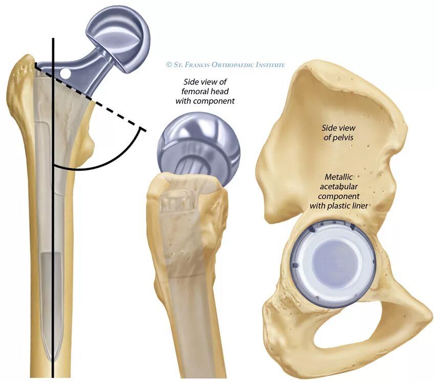 Тазобедренный сустав операция показать. Тазобедренный эндопротез Эскулап. Эндопротезирование коленного и тазобедренного сустава. Тазобедренный эндопротез Зиммер. Эндопротезы тазобедренные Stryker.