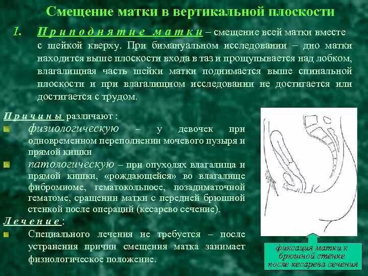 Опущение матки операция отзывы форум. Смещение половых органов у женщин. смещение матки по вертикальной плоскости. смещение матки причины.
