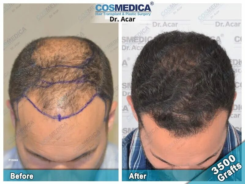 Cosmedica Klinik Türkiye'de Saç Ekim Merkezi
